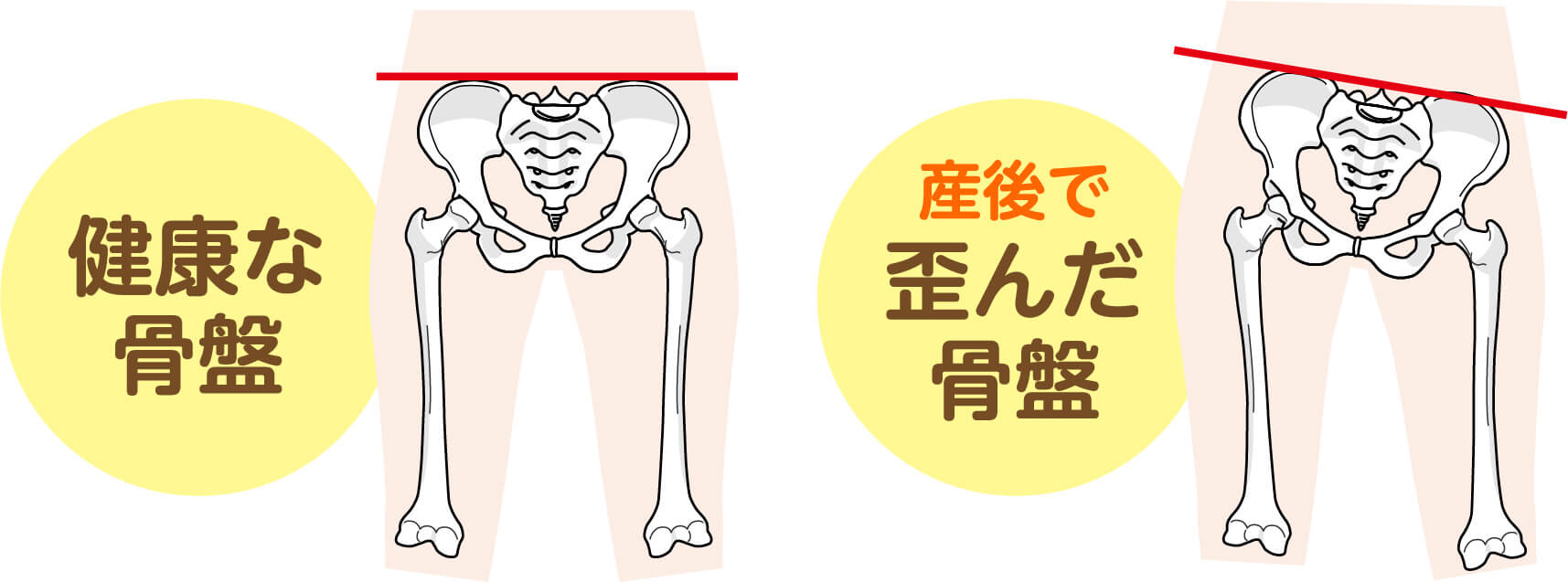 健康な骨盤と産後で歪んだ骨盤の比較イラスト